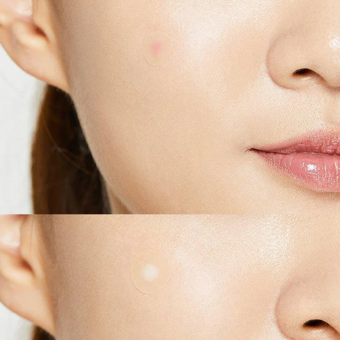[COSRX] Acne Pimple Master Patch